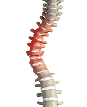 Degenerative Scoliosis