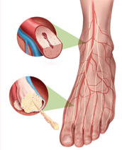 Diabetic Peripheral Neuropathy