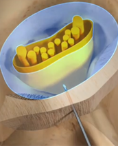 Epidural Steroid Injections / Neuroplasty