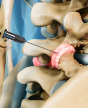 Facet Injections / Medial Branch Blocks