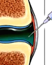 Intra-Articular Injections, including Supartz and Stem Cell