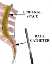 Lysis of Adhesions - Racz katheter