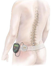 Spinal Cord Stimulator / Peripheral Nerve Stimulator