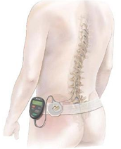 Spinal Cord Stimulator  Peripheral Nerve Stimulator – Integrative