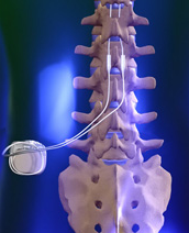 Spinal Cord Stimulator