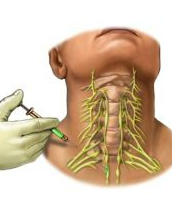 Stellate Ganglion Blocks