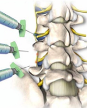 Sympathetic Nerve Blocks & RFTC