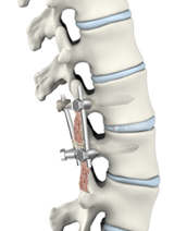 Transforaminal Lumbar Interbody Fusion