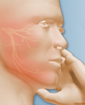 Trigeminal Neuralgia